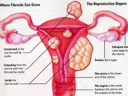 Kebanyakkan wanita pernah mengalami penyakit cyst ini sehingga. Ramai Wanita Tak Tahu Ada Cyst Fibroid Adakah Anda Berisiko Pesona Pengantin
