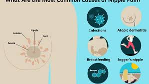Effects of breast pain during pregnancy. Causes Of Nipple Pain