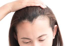 Bellow you can find amazing examples of haircuts and styles that will enhance your features, make you feel confident and attract all the compliments. Hairline Lowering Surgery Or Hair Transplant All You Need To Know