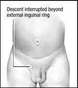 The word is from the greek κρυπτός (kryptos), meaning hidden, and ὄρχις (orchis), meaning testicle. Cryptorchidism Nurse Key