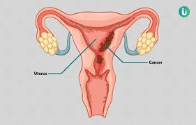 There are usually no other symptoms or warning signs in early endometrial cancer. Endometrial Cancer Uterine Cancer Symptoms Causes Treatment Medicine Prevention Diagnosis