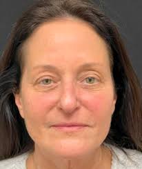 Facelift Before and After Photos