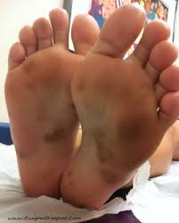 Image result for brown patches on the feet