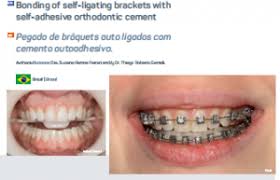 Orthodontic bands are rings that are fitted around your back teeth to provide an anchor for your braces. Ortho Bite Fgm Dental Group