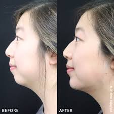 Chin and Jaw Contouring