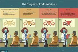 Because the four stages of endometriosis do not necessarily have any correlation to a patient's symptoms or the nature of the infiltration itself, we often use a more. Stages Of Endometriosis
