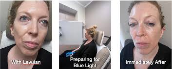 I Tried Photo Dynamic Therapy