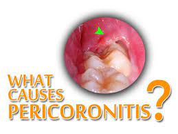 What Causes Pericoronitis Pericoronitis Will Develop Once Wisdom Teeth Solely Part Erupt This Ena Dental Health Care Dental Health Emergency Dental Treatment
