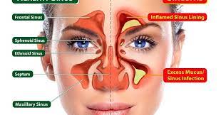 Itu tanda ia pecah dari dalam. Pengedar Shaklee Seremban Negeri Sembilan Resdung Menyebabkan Jerawat