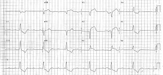 Tachycardia (out of proportion to fever) tachypnea. Myocarditis In Children Requiring Critical Care Transport Intechopen