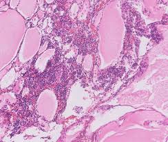 Image result for Nephroblastoma