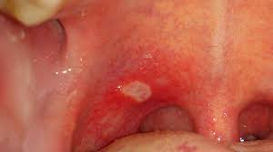 Como quitar una postemilla de la encia rapidoefecto del té negro en las encías que es buenísimo pues se trata de un antinflamatorio y antioxidante destaca. Aftas Orales Causas Sintomas Y Tratamiento