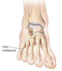But they really restrict you for a week or two, then you can row or use upper body, low weight when people decide to drop unwanted body fat the immediate knee jerk reaction is both emotional and extreme. Understanding Fifth Metatarsal Fracture