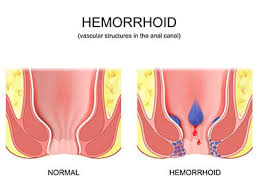 Image result for hemoroid human