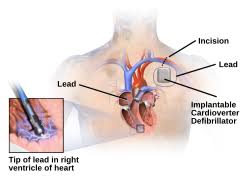Image result for Internal Cardiac Defibrillator
