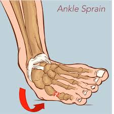 Patients can bear weight but do so with a sense of instability and a visible limp. Low Ankle Sprain
