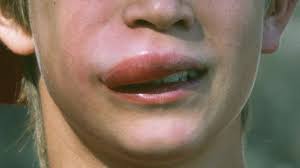 Beware of risks and dangers. What Bit Me How To Identify Common Bug Bites Everyday Health