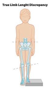 Image result for Functional Leg Length Discrepancy