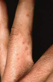 Ubersehen Sie Die Scabies Nicht Springerlink