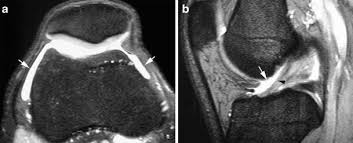 This section of the website will explain large and minute details of sagittal knee . Synovial Recesses Of The Knee Mr Imaging Review Of Anatomical And Pathological Features Springerlink