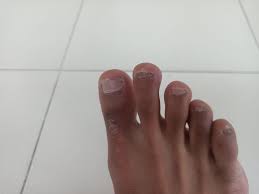 Image result for Onychotillomania feet