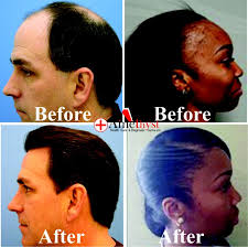 You can try looser hairstyles, or buy secure wigs that won't stress your hairline. Get Your Hairline Back Health Nigeria