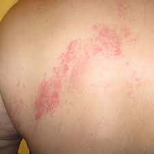 Infected Sores That Are Not From Spider Bites