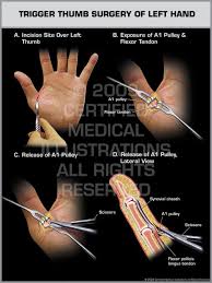 Flexor tendons will heal if positioned without tension or stress; Pin On Tendonitis