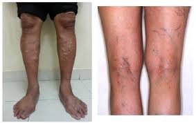 Apa yang menyebabkan vena varikos? 10 Fakta Berkenaan Varicose Veins Myumaimah Com