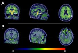 All of his stays have been at international hospitals. Amyloid And Tau Pet Imaging Of Alzheimer Disease And Other Neurodegenerative Conditions Sciencedirect