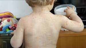 Select from premium coxsackie virus of the highest quality. Coxsackie Virus Facts Parents