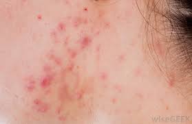 Doxycycline hcl with proven performance. Is It Safe To Combine Doxycycline And Dairy With Pictures