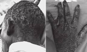 A psoriase é uma afecção de pele caracterizada por a psoriase é uma doença inflamatória crónica da pele que afecta cerca de 2% da população, e que se. Psoriase Extensa Das Maos E Couro Cabeludo Apos Abandono Da Download Scientific Diagram