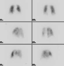 Image result for Ventilation Perfusion Scan