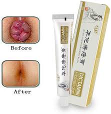 Check spelling or type a new query. All In Best Choice Hemorrhoids Ointment Cream Chinese Medicine Huatuo Shrink Swollen Hemorrhoid Tissue Reduce Heat And Inflammation Relieve Hemorrhoid Pain Clear Away Toxic Materials Remove Decayed Tissues Lazada Ph