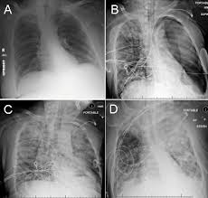 Image result for Air Bronchogram