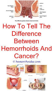 Hemorrhoids Are A Troublesome Trouble That Can Be Protected Against Right Here Are Some Ideas Wherefore Bleeding Hemorrhoids Cure For Hemorrhoids Hemorrhoids