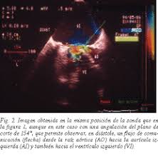 Es probable que las reglas de la interacción social en rusia sean diferentes a las de tu país. Doble Trayecto Fistuloso Entre La Raiz Aortica Y Ambas Cavidades Cardiacas Izquierdas Diagnostico Mediante Ecocardiografia Transesofagica Multiplanar Revista Espanola De Cardiologia