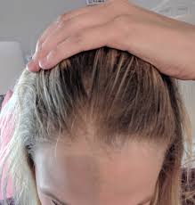 Beans and legumes, citrus fruits, wheat bran, whole grains, poultry, liver, green leafy vegetables. Hair Regrowth From Insulin Reduction With Photos Pcos