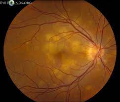 Here's what you need to know. Acute Posterior Multifocal Placoid Pigment Epitheliopathy Apmppe