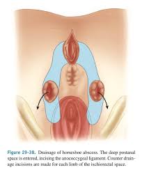 Image result for Ischiorectal Abscess