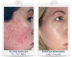 Image result for demodex rosacea