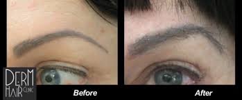 You'll notice some scabbing around the brows within the first few days. Eyebrow Hair Transplant Process How Does It Work