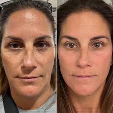 Say goodbye to tired eyes and hello to a refreshed, youthful glow! ✨ Our  talented aesthetician @fullspecialist_farrah worked her magic with an  under-eye chemical peel, transforming dull, tired skin into bright,  rejuvenated