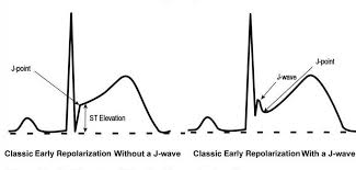 Image result for Early Repolarization