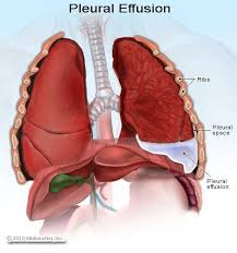 Pleural effusion is classically divided into transudate and exudate based on the light criteria. 20 Pleural Effusion Causes Symptoms Treatment Complications