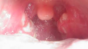 Image result for Strep throat infection roof of mouth