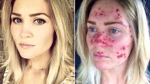 This skin cancer also develops in people who have darker skin. Woman S Skin Cancer Selfies Go Viral And Inspire Skin Checks Allure
