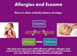 Image result for Allergic Triad