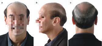 Wigs and Hair Prosthesis